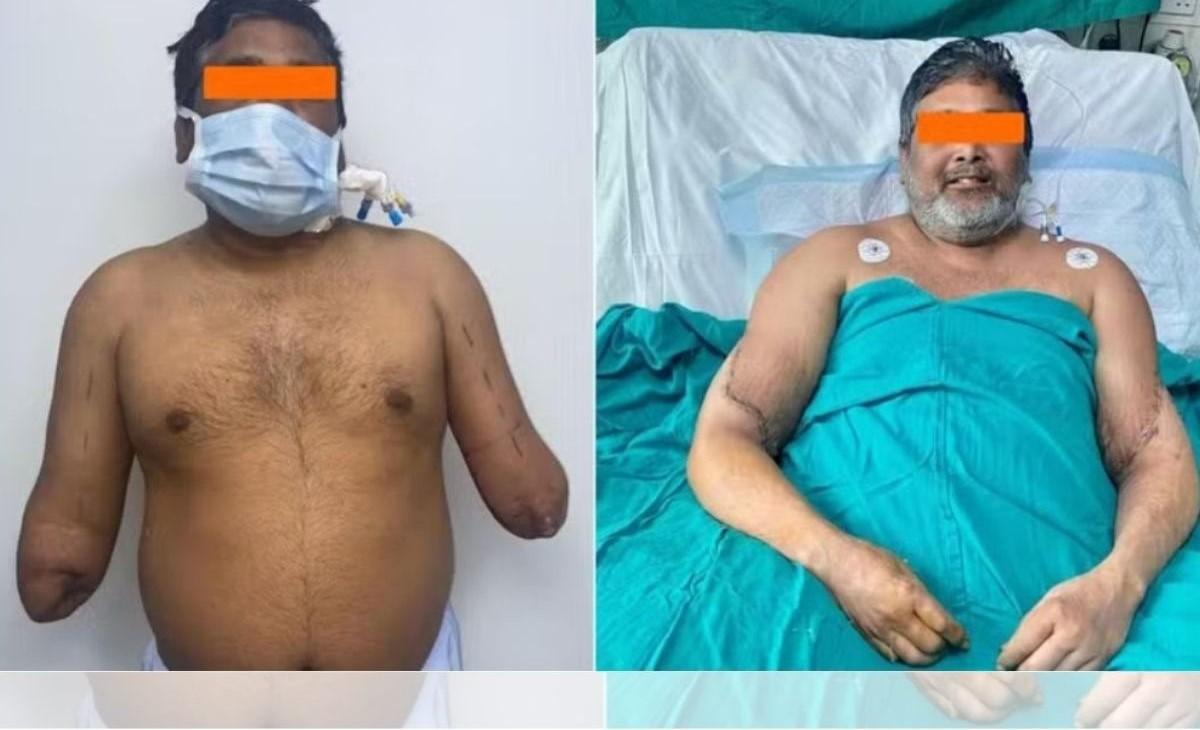 Indiano recupera as 2 mãos após fazer transplante de alta complexidade