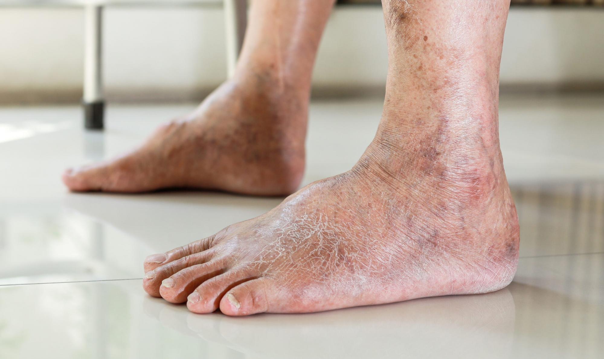 O que seus pés têm a ver com problemas no fígado?