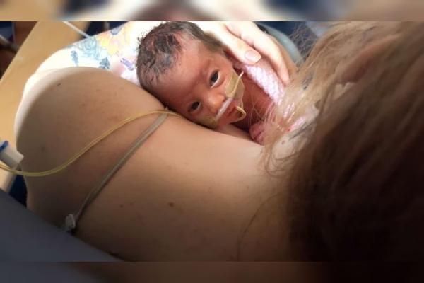 Bebê nasce com órgãos para fora da barriga, é enrolada em filme PVC e sobrevive