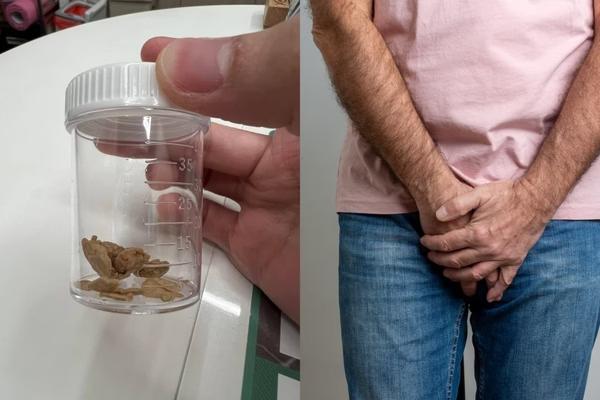 Homem fica com várias pedras de sujeira após 30 anos sem lavar o pênis
