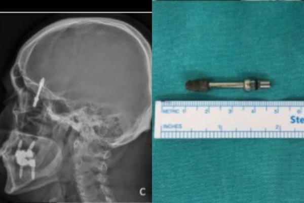 Parafuso de implante dentário vai parar no cérebro de paciente