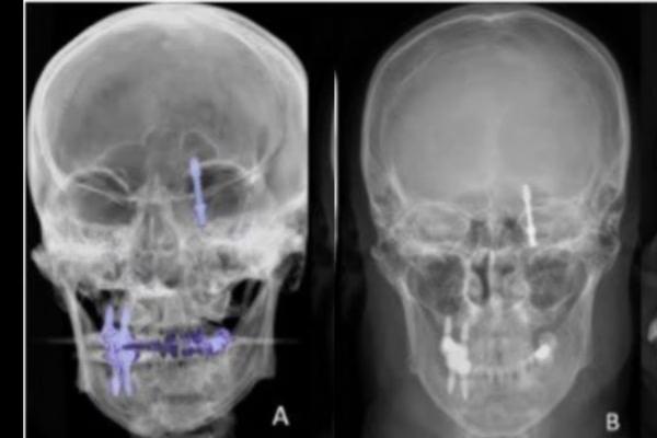 Parafuso de implante dentário vai parar no cérebro de paciente