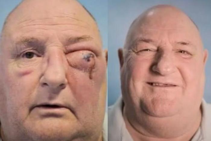 Homem contrai bactéria após infecção no dente e quase perde o olho