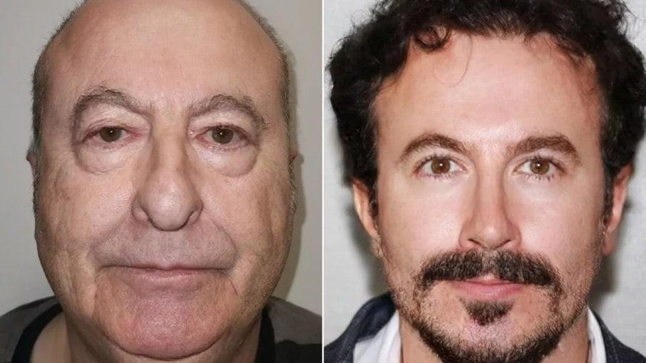 Homem fica ‘30 anos mais jovem’ após cirurgias na Turquia; veja fotos