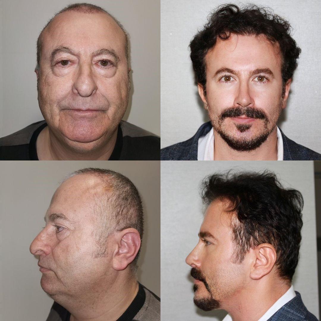 Homem fica ‘30 anos mais jovem’ após cirurgias na Turquia; veja fotos