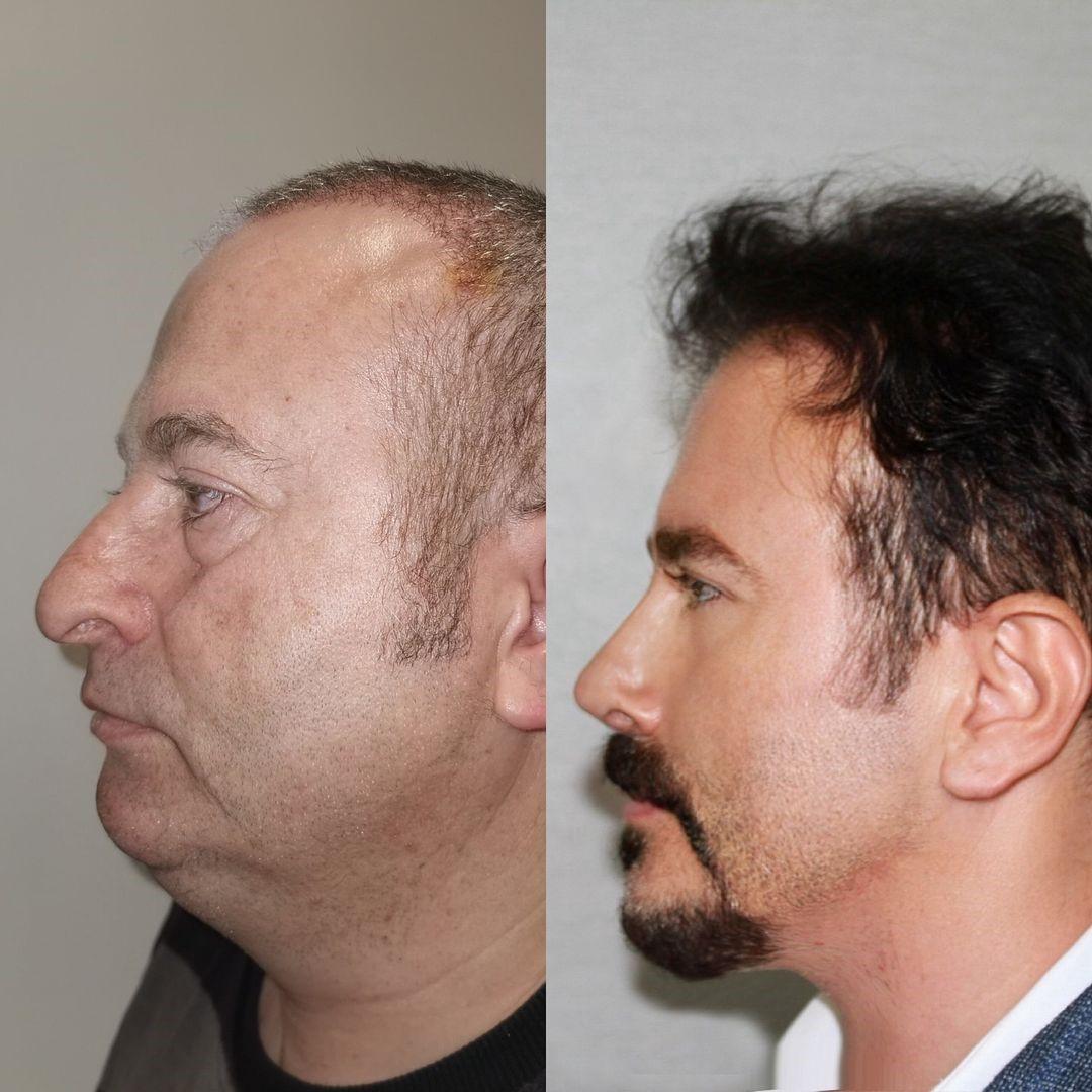 Homem fica ‘30 anos mais jovem’ após cirurgias na Turquia; veja fotos