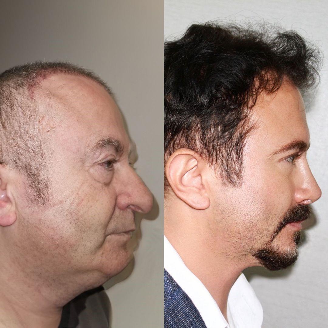 Homem fica ‘30 anos mais jovem’ após cirurgias na Turquia; veja fotos
