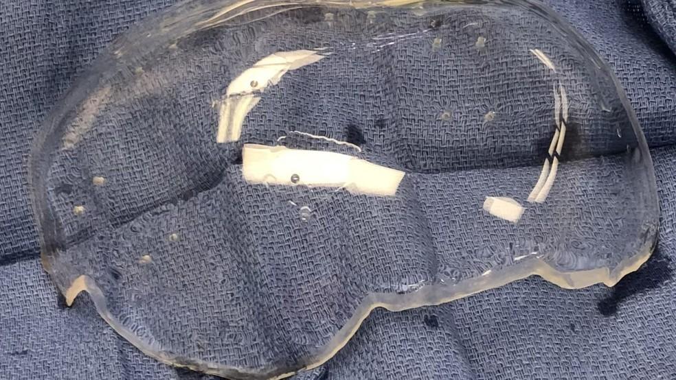 Cirurgia inédita no cérebro abre ‘janela’ em crânio de paciente