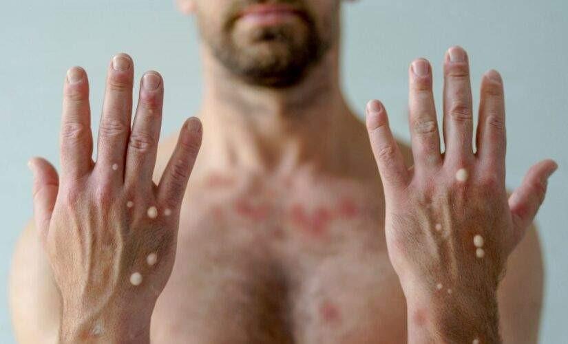 ES tem 48 casos confirmados de mpox; número é maior que todo ano passado
