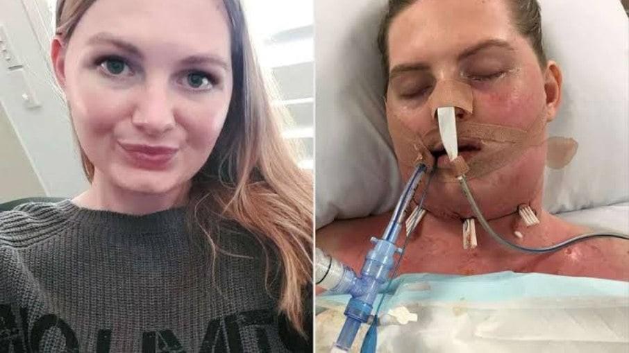 Inflamação de siso quase mata e deixa mulher de 23 anos em coma