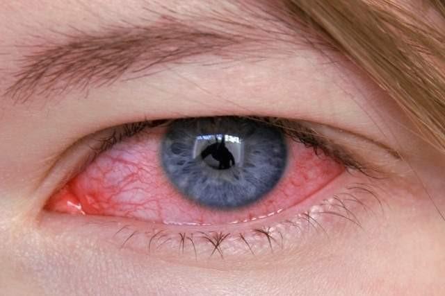 “Nuvem” de fumaça pode causar desidratação nos olhos