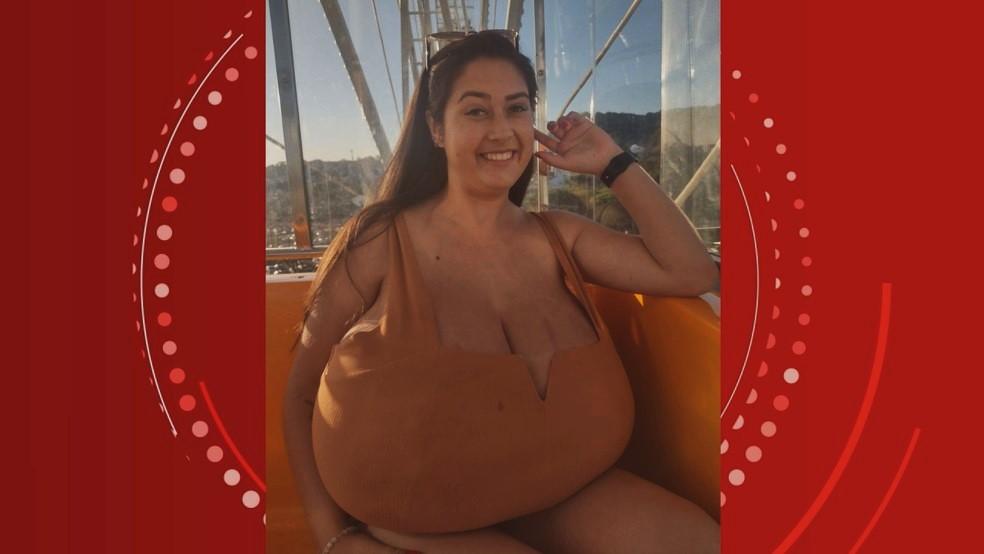 Jovem com gigantomastia faz cirurgia e retira 10 kg de mama: “Não estava mais aguentando”