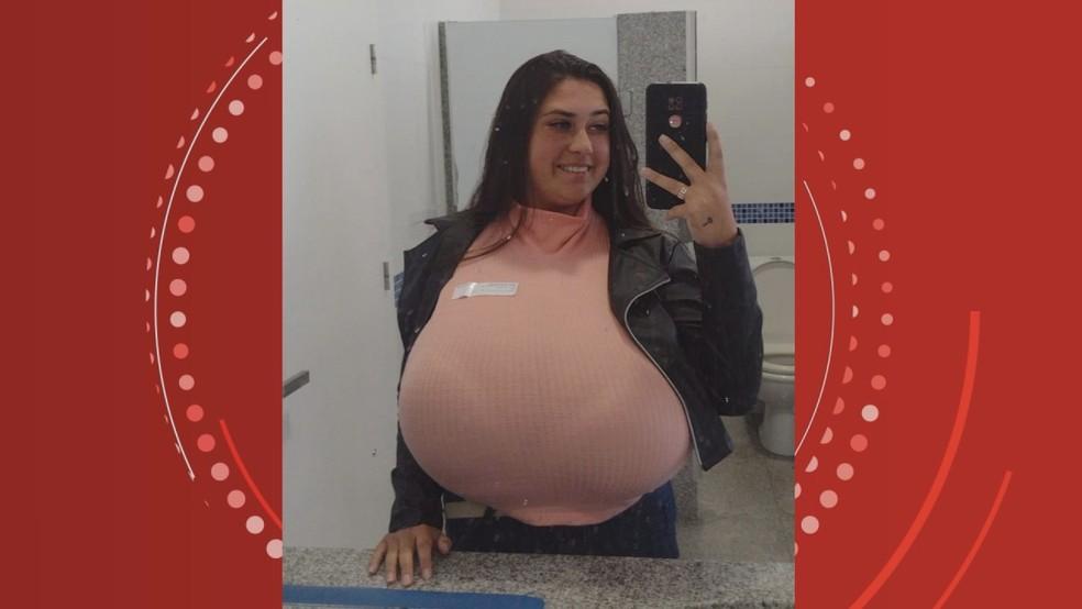 Jovem com gigantomastia faz cirurgia e retira 10 kg de mama: “Não estava mais aguentando”