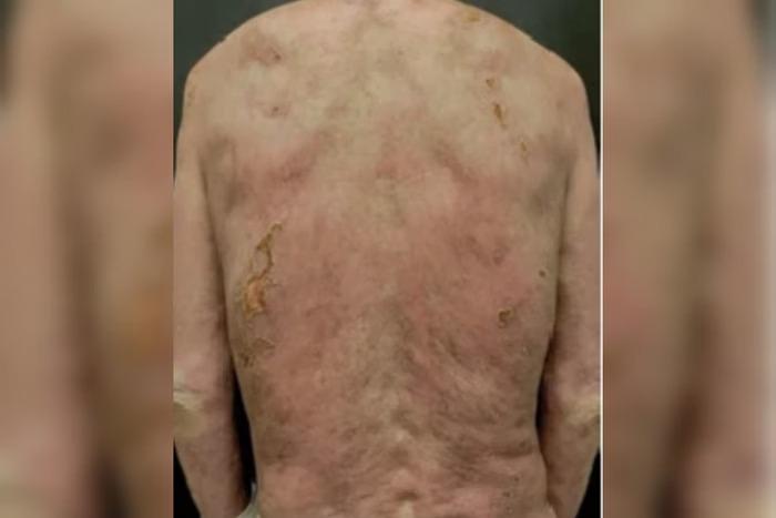 Ciência acha cura para doença de pele mortal