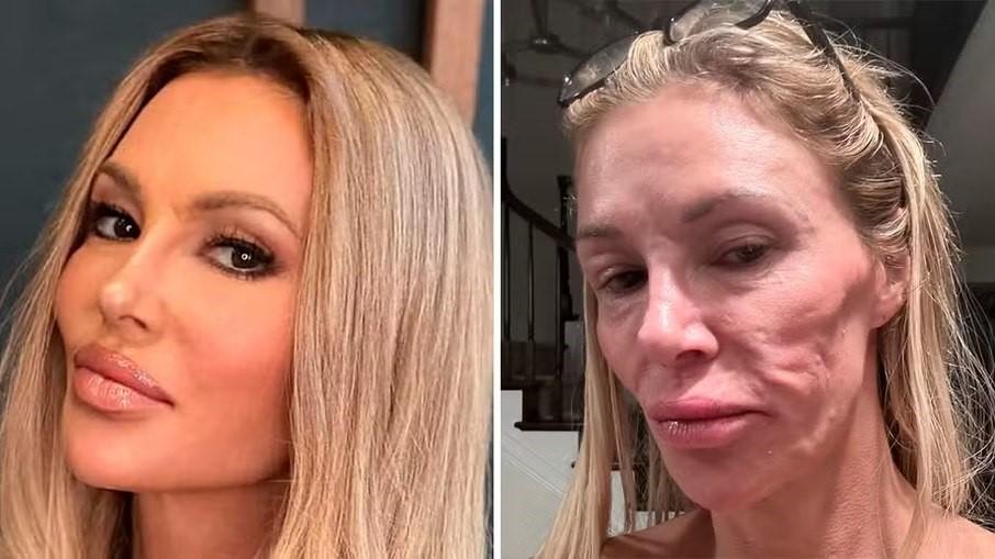 Ex-estrela de reality tem rosto ‘derretido’ e acusa emissora como causadora da condição