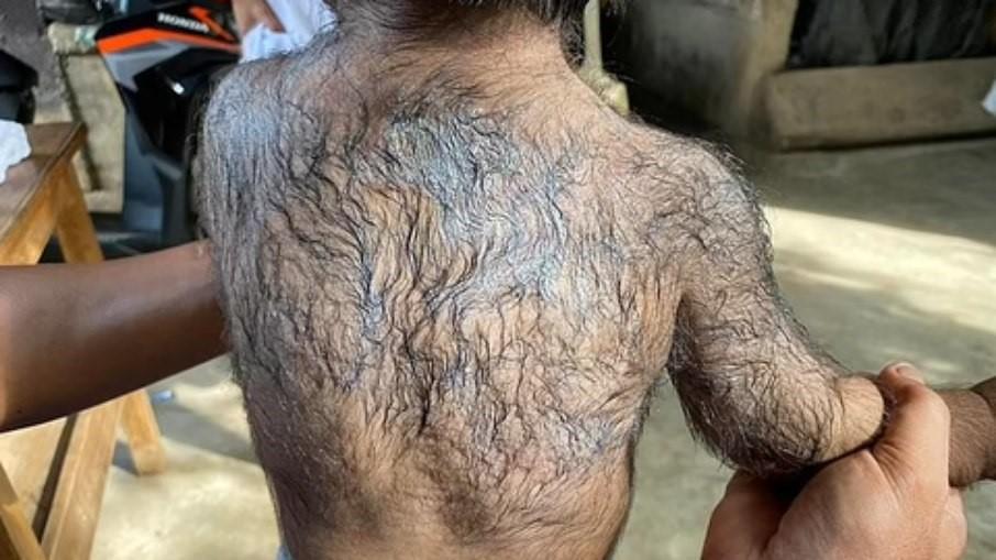 Bebês ficam “peludos” após pais usarem famoso produto contra queda capilar Bebês ficam “peludos” após pais usarem famoso produto contra queda capilar