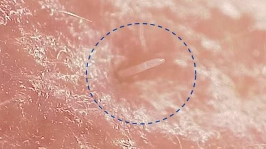 Ácaros que vivem na pele estão se fundindo com o nosso corpo