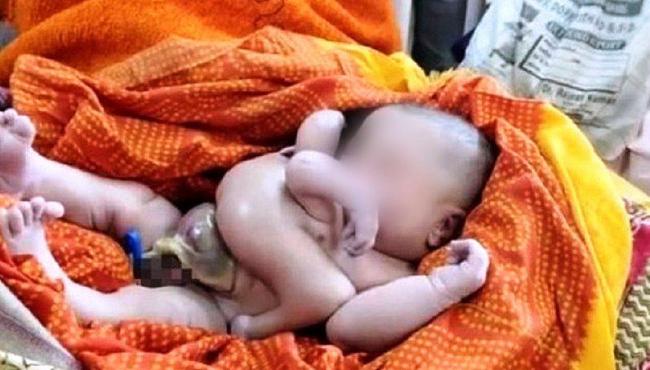 Bebê com quatro braços e quatro pernas é tratado como Deus na Índia