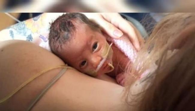 Bebê nasce com órgãos para fora da barriga, é enrolada em filme PVC e sobrevive