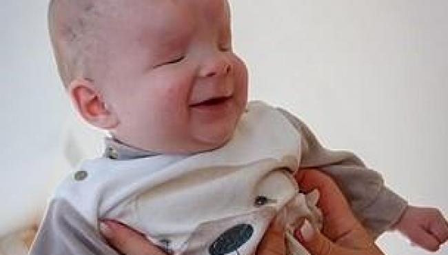 Bebê que nasceu sem olhos é colocado para adoção