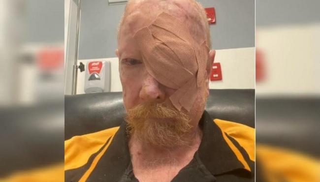 Câncer de pele: homem retira 200 tumores e fica com face desfigurada