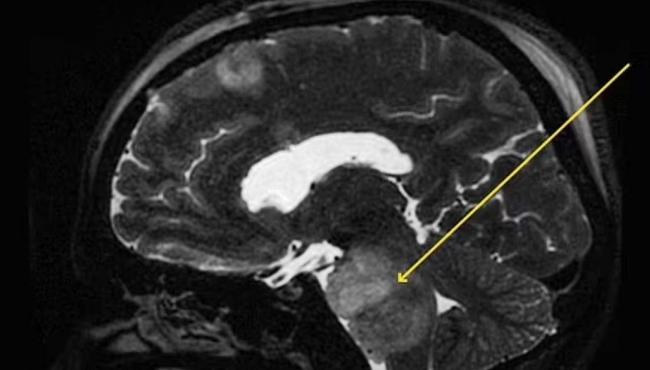 Crise de soluço de quatro meses em indiano pode ter sido causada por tumor no cérebro
