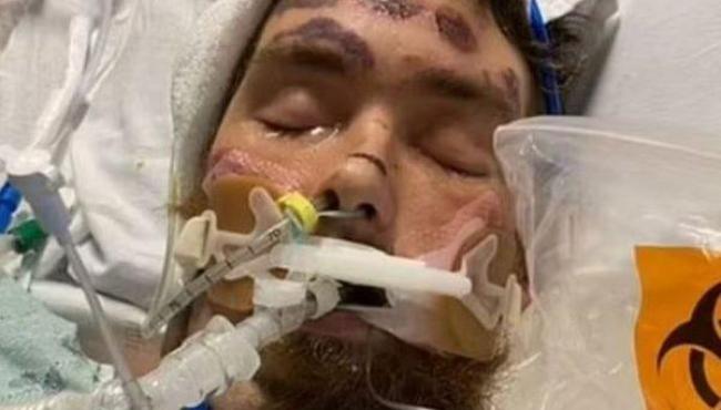 Homem fica em coma após tentar remover pelo encravado da virilha