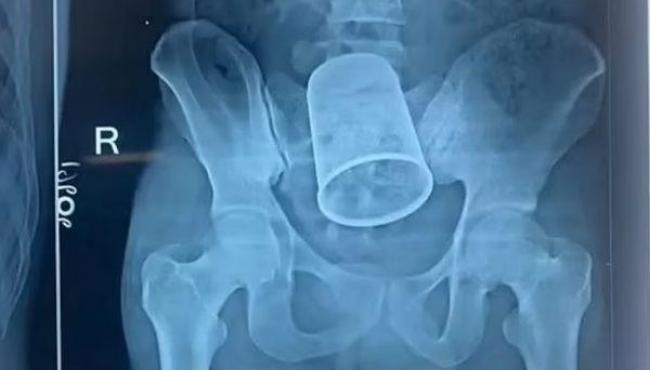 Homem passa por cirurgia para retirar copo de metal do ânus