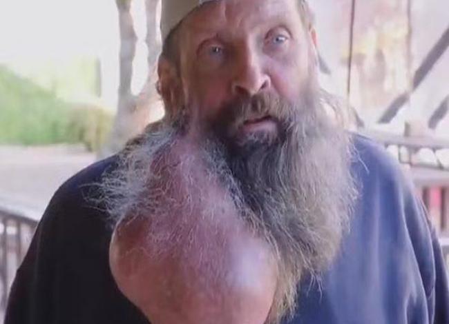 Homem remove tumor gigantesco do rosto e pescoço após 16 anos