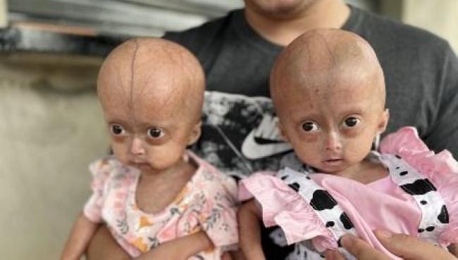 Irmãs gêmeas de 1 ano e 7 meses são diagnosticadas com síndrome rara da velhice precoce, em RR