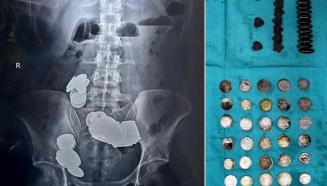 Jovem é operado após engolir 39 moedas e 37 ímãs alegando que 'zinco ajuda na musculação'