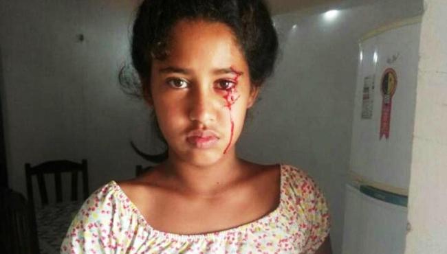 Lágrimas de sangue: Menina de 12 anos busca diagnóstico para doença
