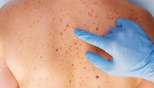 Manchas de sol na pele: como tratar no rosto, braço, costas, colo e mais