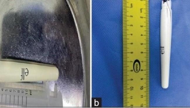 Médicos removem caneta de 10 cm da bexiga de adolescente