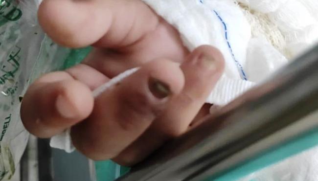 Menina é levada a hospital sem unhas e tem remoção de 40% do intestino