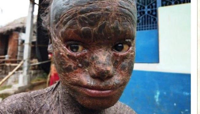 Menino de 10 anos sofre de condição rara que o deixa com “pele de cobra”