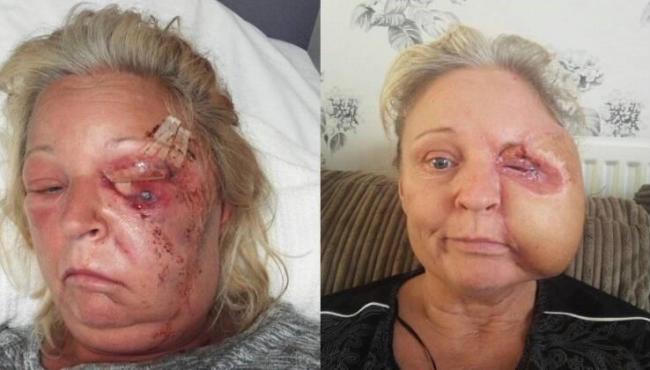Mulher perde metade do rosto após ser infectada por bactérias devoradoras de carne