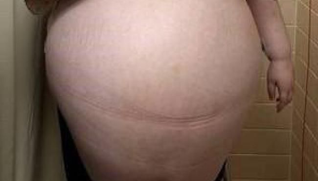 Mulher remove tumor de 47 kg no ovário: ‘'A sensação era de estar grávida de dez filhos’