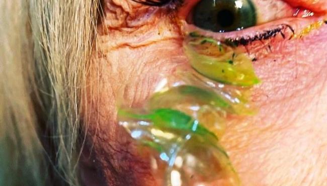 Oftamologista remove 23 lentes de contato perdidas em olho de paciente