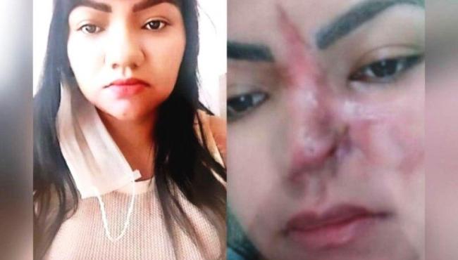 Polícia Civil apura caso de mulher que perdeu parte do nariz em cirurgia estética feita por dentista
