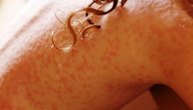 Sarna humana: doença contagiosa da pele causada por parasita